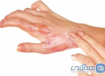 کمکهای اولیه لازم بعد هر نوع سوختگی